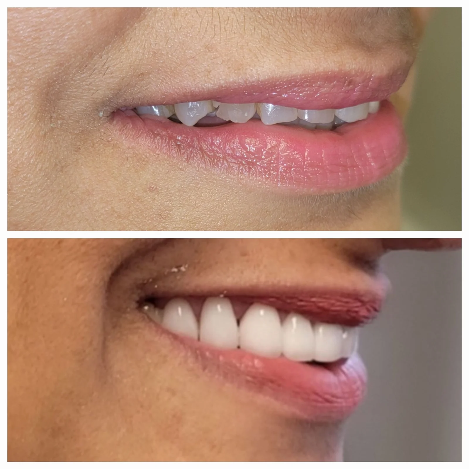 Before and after cosmetic dental treatment - side profile showing improved smile