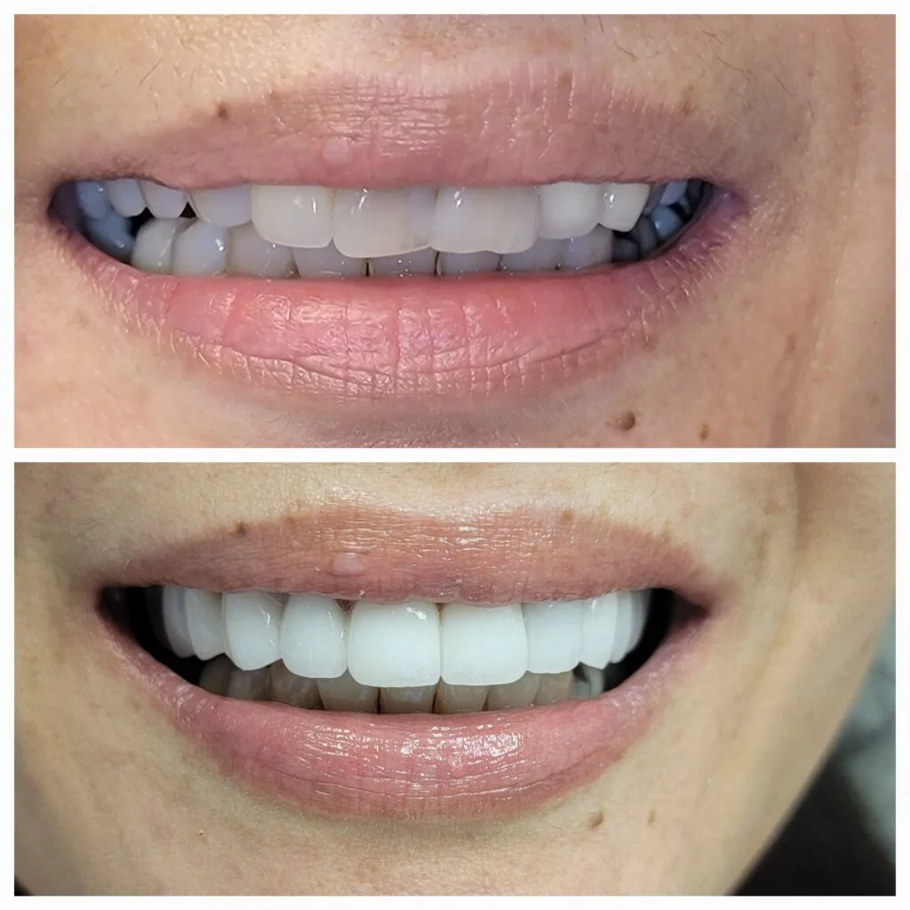 Before and after cosmetic dentistry - veneers for a brighter smile