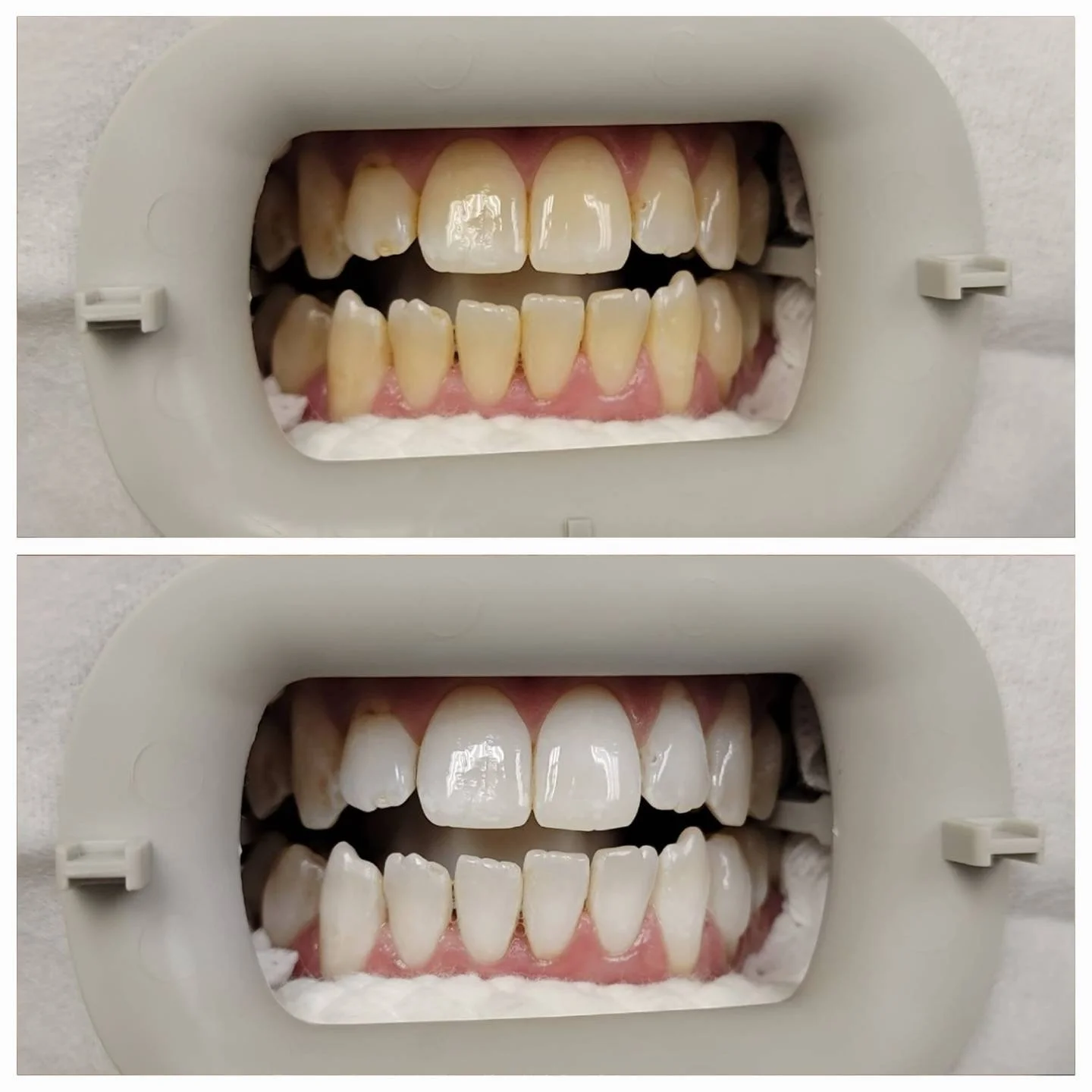 Before and after teeth whitening at Dr. Jitendra Acharya
