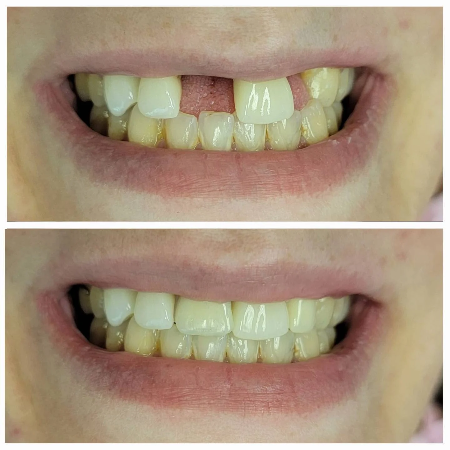 Before and after dental restoration — crowns and bridges at Dr. Jitendra Acharya