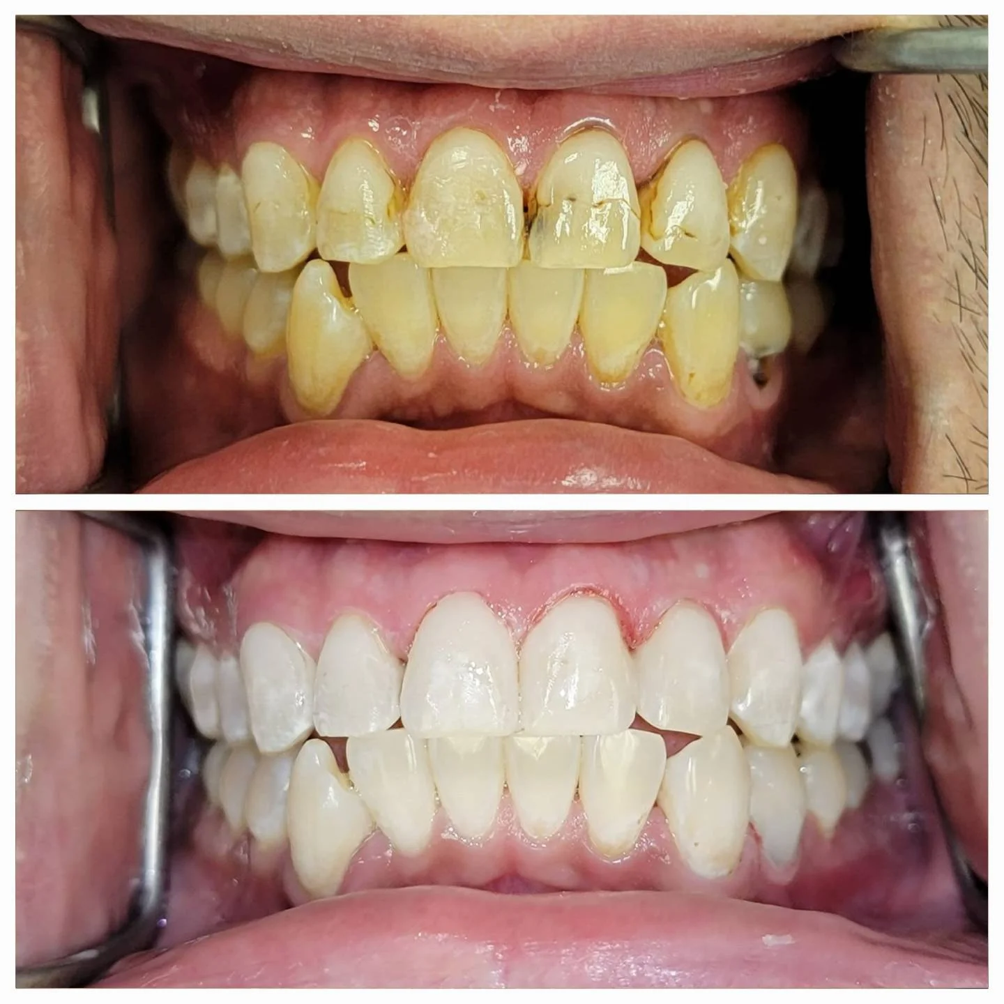 Before and after deep cleaning and whitening - heavy staining removed