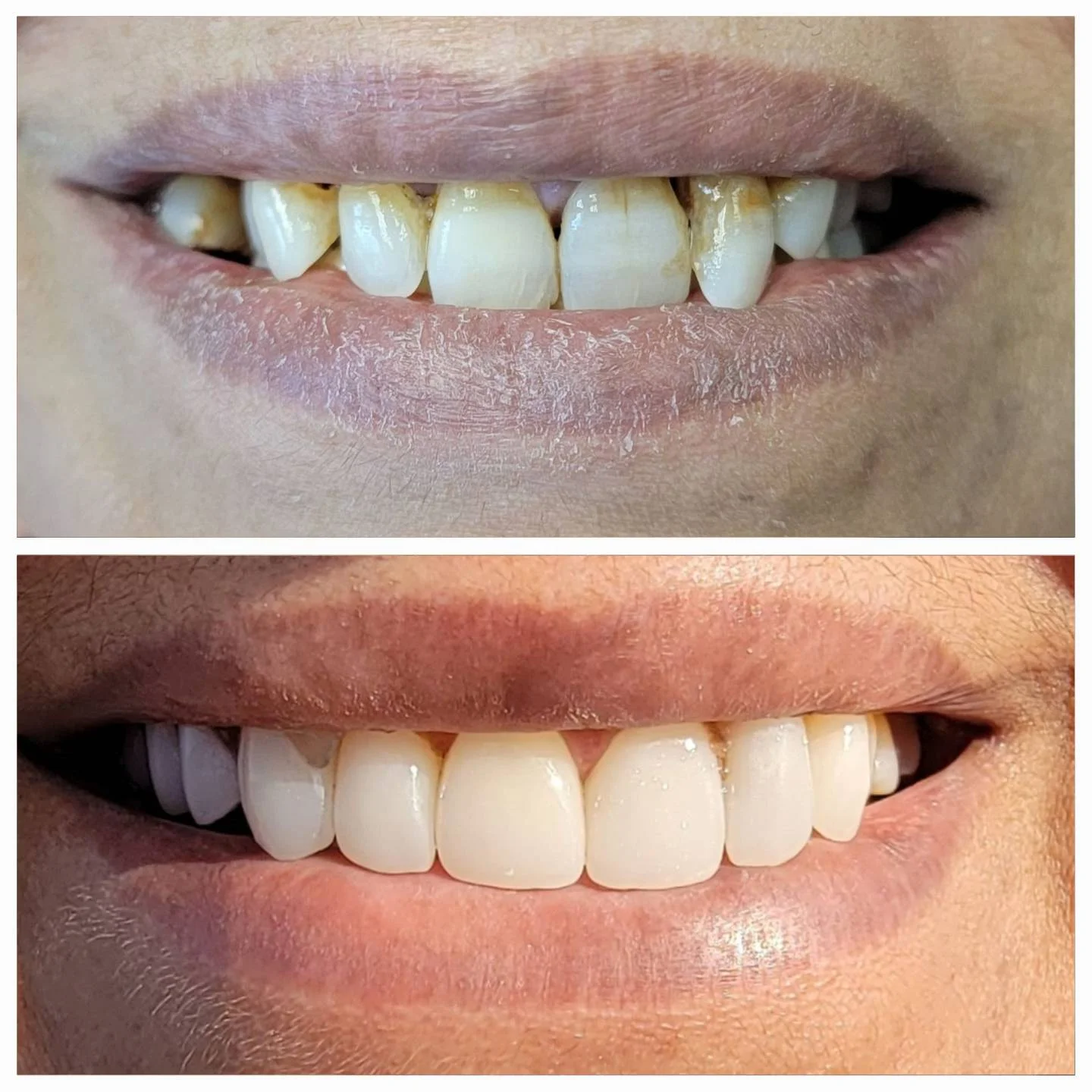 Invisalign treatment results at Dr. Jitendra Acharya