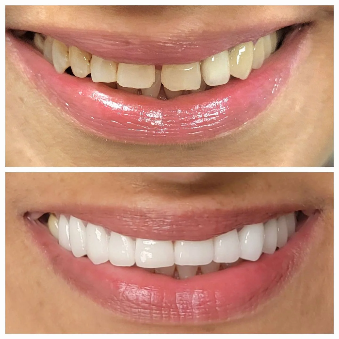 Real patient dental treatment before and after at Dr. Jitendra Acharya